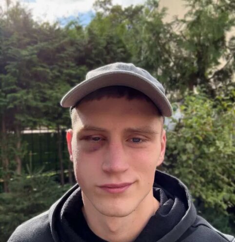 E. &Scaron;alkovskis pavie&scaron;ino, kaip atrodo jo veidas po Pauliukevičiaus smūgio: atskleidė, kokie sužeidimai